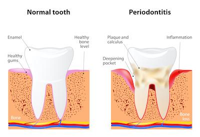 A diagram of a healthy tooth, and a diagram of a tooth with gum disease