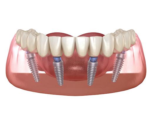 dental implants long beach ca