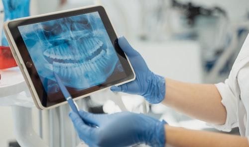 A panoramic x-ray of a patient's teeth