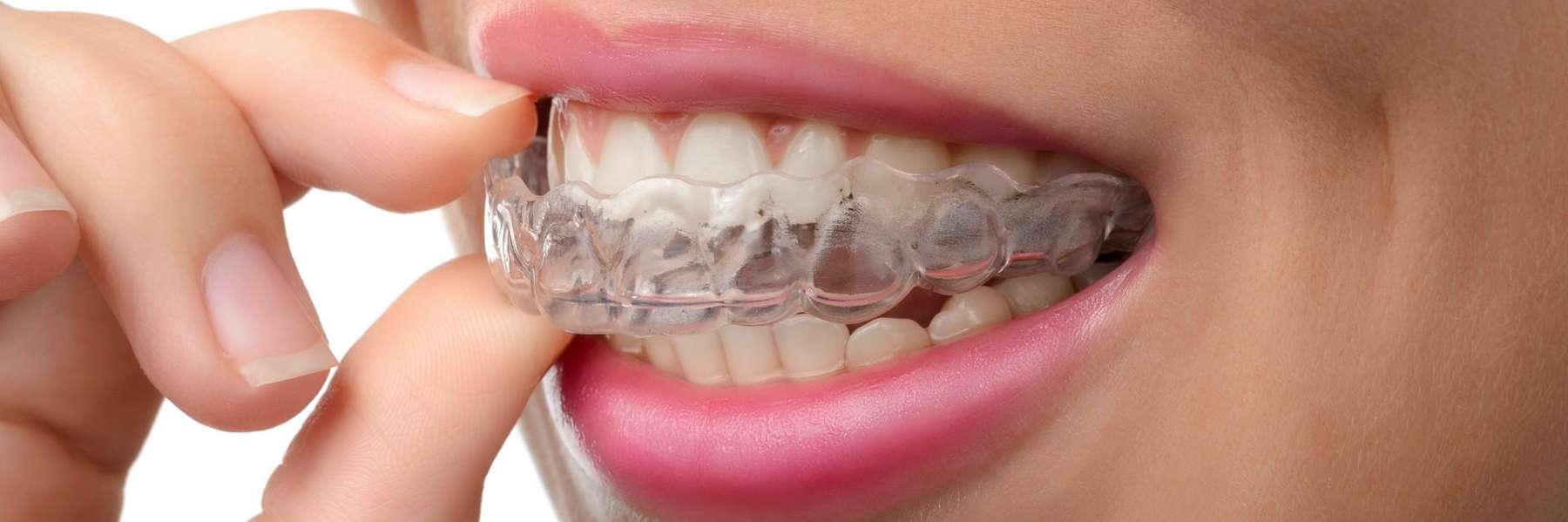 A woman putting in her Invisalign tray in Long Beach