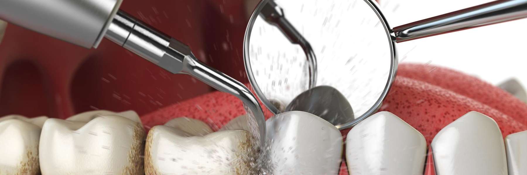 A dental technician uses a tool for teeth cleaning, ensuring optimal patient care.