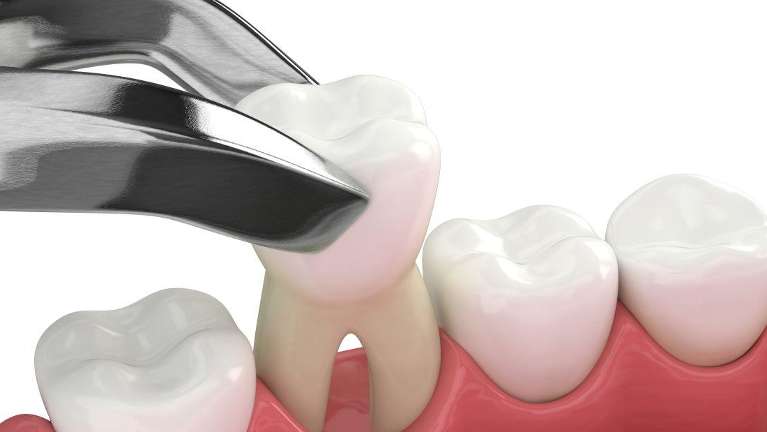 An illustration of a tooth extraction | Long Beach dentist