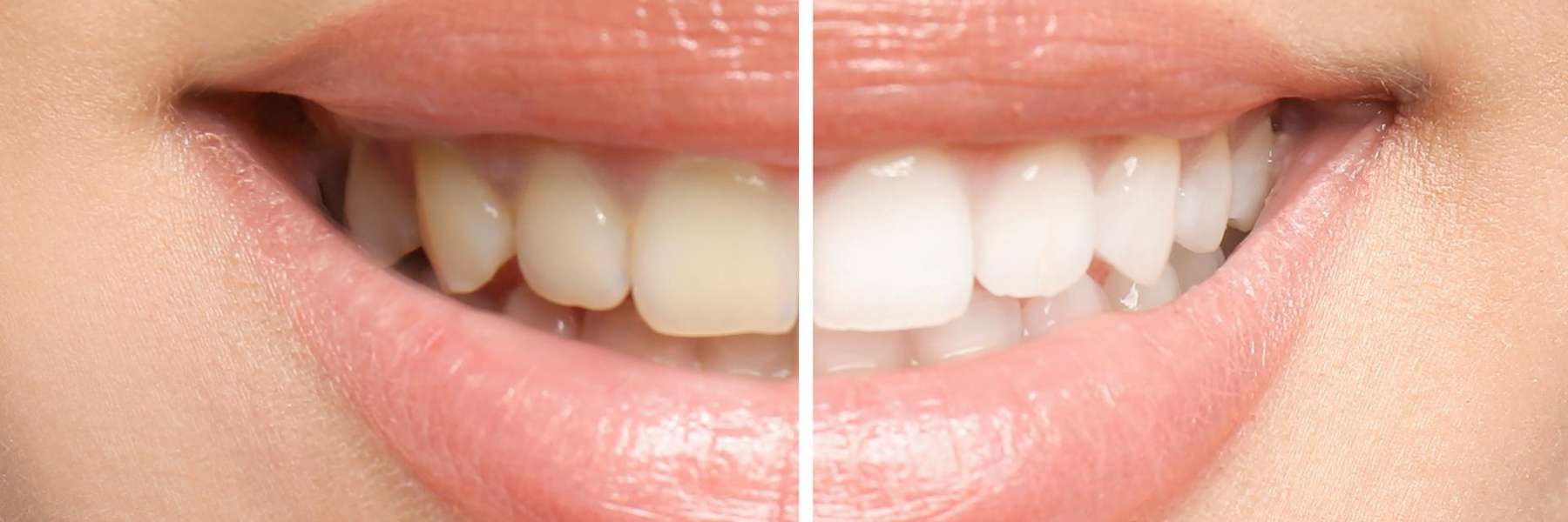 A woman’s teeth before and after whitening show professional results.