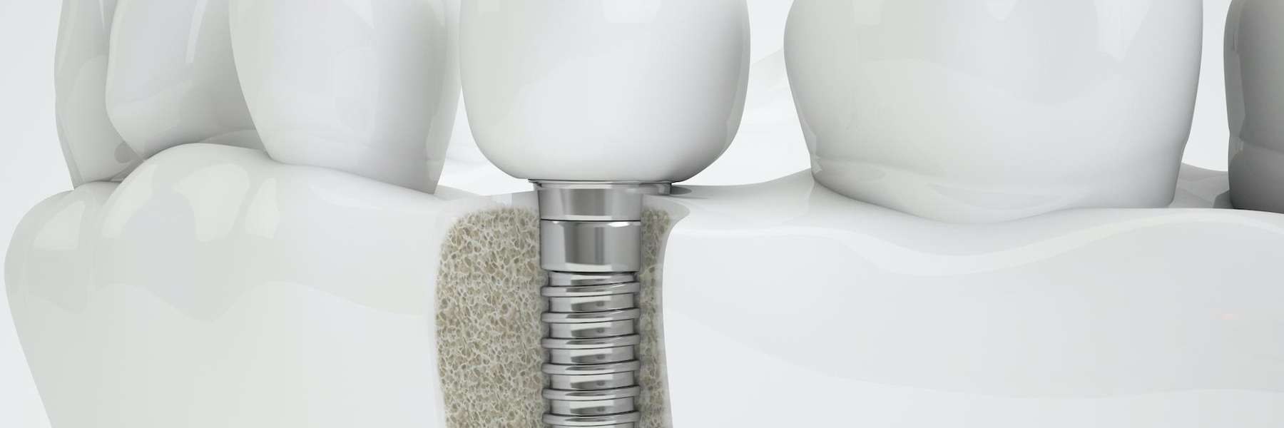 A diagram of a dental implant and dental implant screw