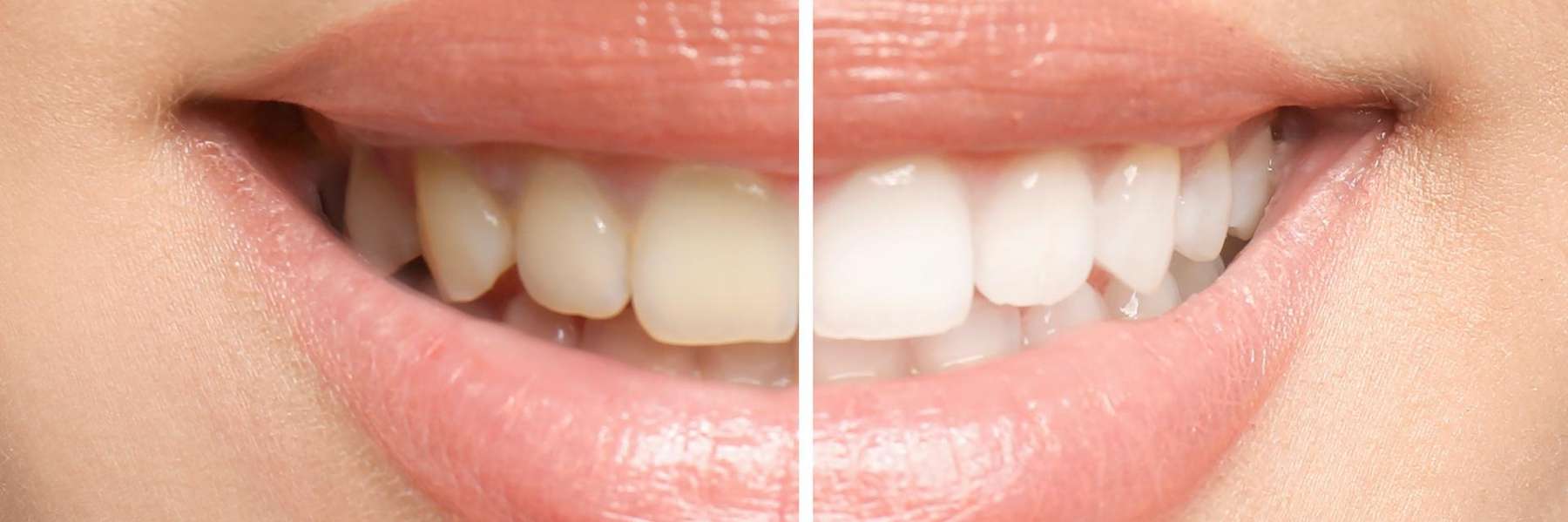 A before and after teeth whitening photo | cosmetic dentist Long Beach