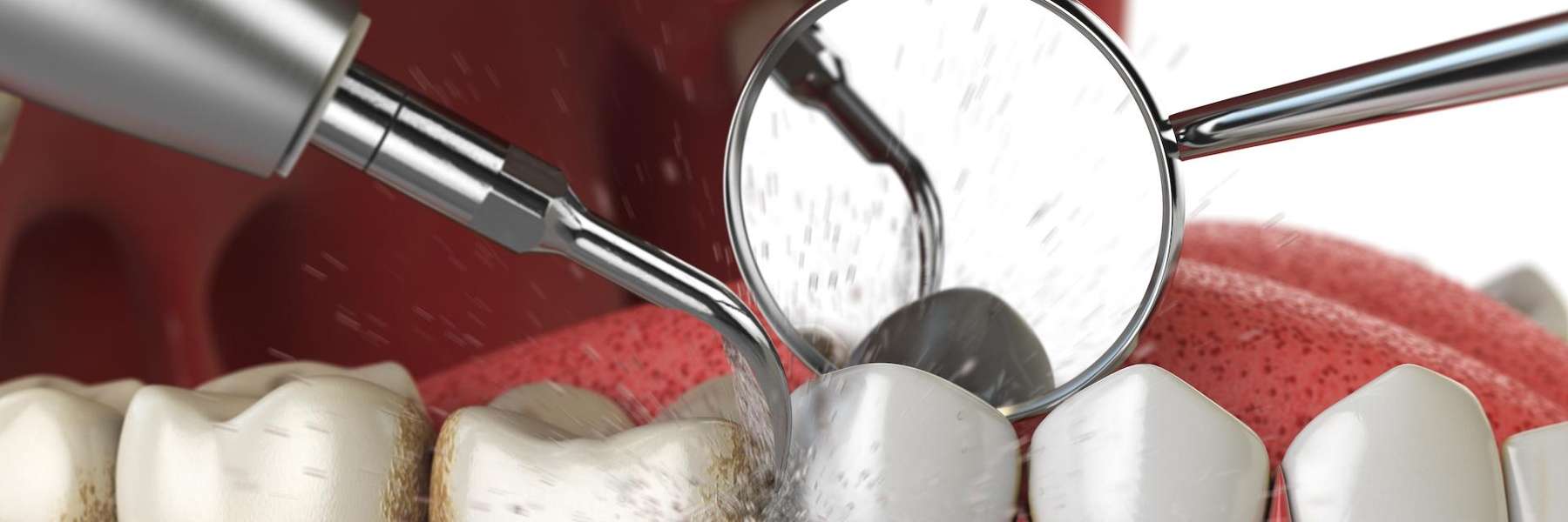 An image of a dental cleaning in Long Beach CA