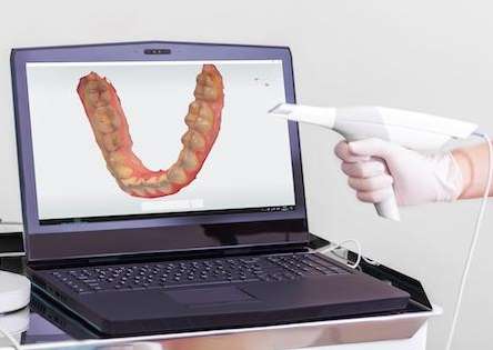 Image of a digital impression