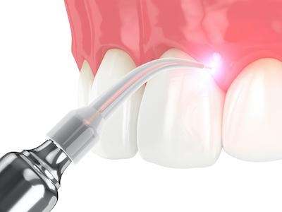 An example image of laser dentistry in Long Beach