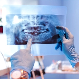 Golden Coast Dental Care image of an exray of teeth